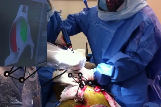 Thay thế khớp háng với sự hỗ trợ của robot phẫu thuật. Ảnh video ITV