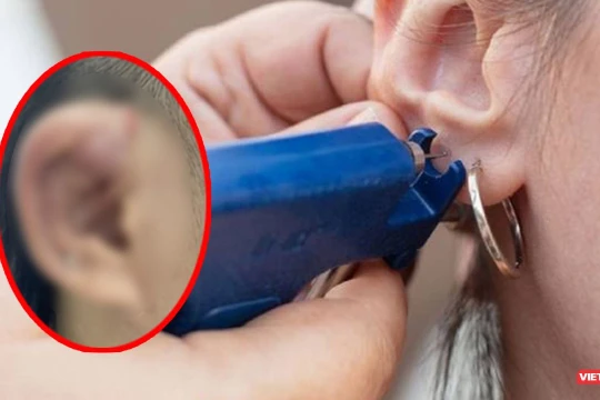 Bệnh nhân bị biến chứng do bấm lỗ tai sai vị trí, không đảm bảo vệ sinh
