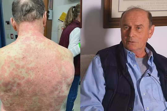 Ông Richard Terrell bị phát ban toàn thân sau khi tiêm vaccine Covid-19 của Johnson & Johnson. Ảnh: Richmond News.