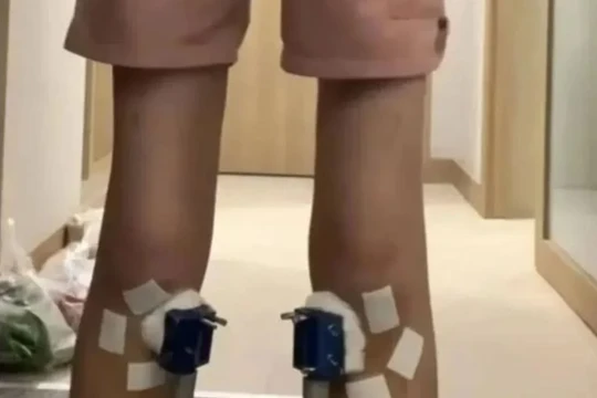 Nam sinh 16 tuổi cao thêm 1,4 cm, nhưng chỉ 2 tuần sau khi dừng trị liệu, phần tăng trưởng ấy biến mất hoàn toàn. Ảnh: OddCentral.