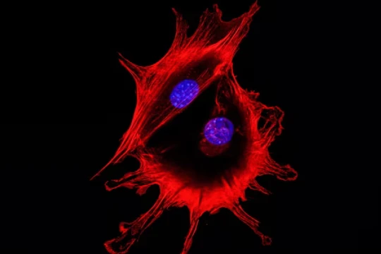 Hình ảnh kính hiển vi của hai tế bào ung thư khi tiếp xúc với nhau. Xét nghiệm dựa trên huyết thanh mới có thể tăng cường phát hiện ung thư ở các nước nghèo (Ảnh: FT)