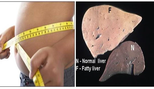 Gan nhiễm mỡ là hậu quả của chế độ sinh hoạt không hợp lý và sử dụng nhiều rượu, bia.