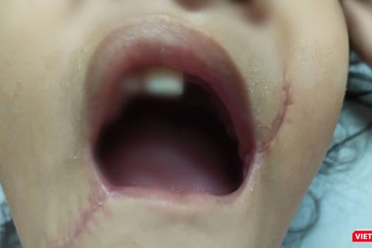 Tổn thương vùng miệng của bé T. đã được các bác sĩ xử trí.