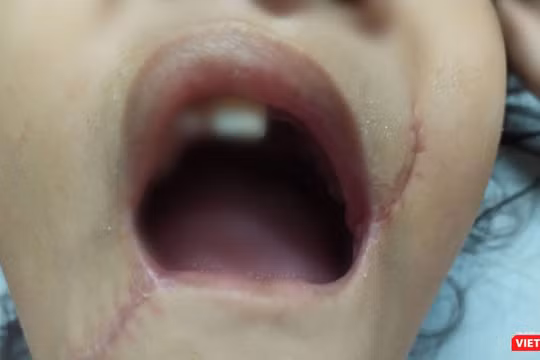 Tổn thương vùng miệng của bé T. đã được các bác sĩ xử trí.