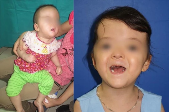 Bệnh nhi trước và sau khi phẫu thuật