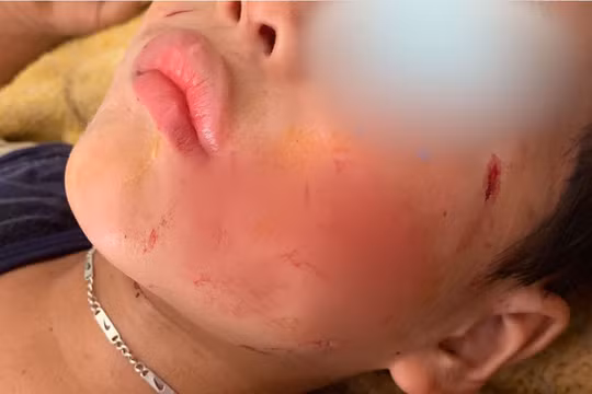 Bé V. 5 tuổi vô tình dẫm phải chó nhà rồi bị chính con chó đó cắn vào mặt và đầu.