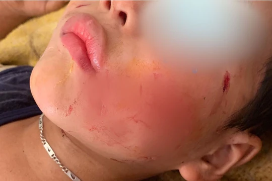 Bé V. 5 tuổi vô tình dẫm phải chó nhà rồi bị chính con chó đó cắn vào mặt và đầu.