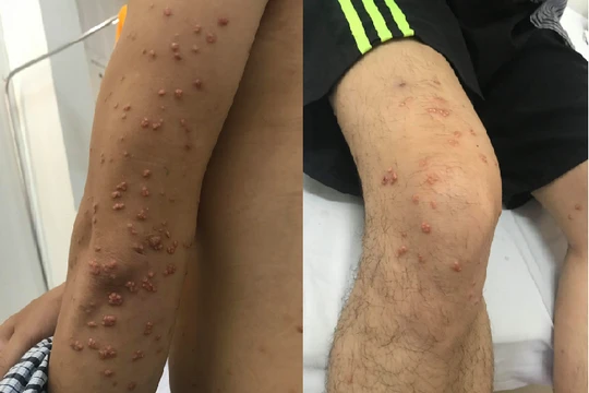 Các nốt sần đặc nhân vàng nổi dày đặc trên tay và chân của anh K.