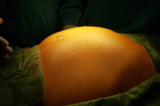 Khối u khiến bụng ông H. chướng to như cái trống.