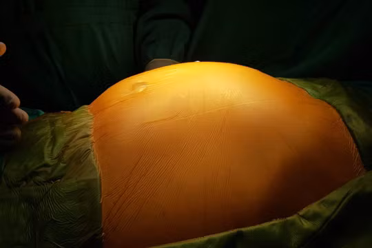 Khối u khiến bụng ông H. chướng to như cái trống.