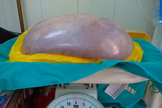 Khối u nặng 8 kg cắt ra từ bụng của chị N.