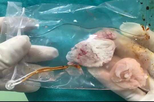 Nang sán làm tổ trong não bệnh nhân