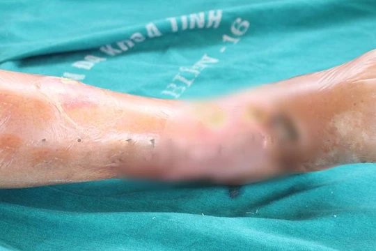 Chân của bệnh nhân bị hoại tử vì tự ý chữa tại nhà