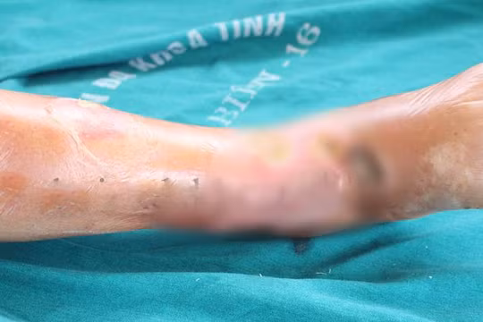 Chân của bệnh nhân bị hoại tử vì tự ý chữa tại nhà