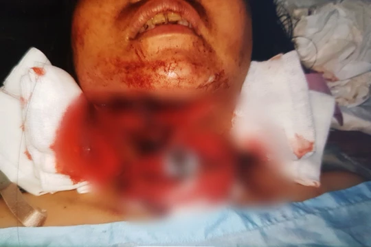 Chị P. bị chấn thương nặng ở vùng cổ