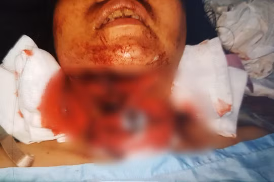 Chị P. bị chấn thương nặng ở vùng cổ