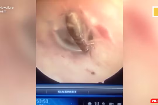 Một con gián nhỏ còn sống đang "vui chơi" trong tai của bệnh nhân