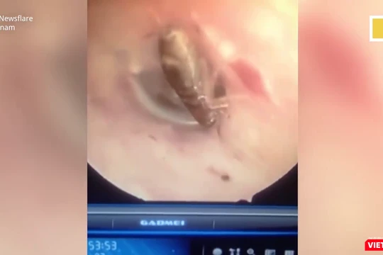 Một con gián nhỏ còn sống đang "vui chơi" trong tai của bệnh nhân