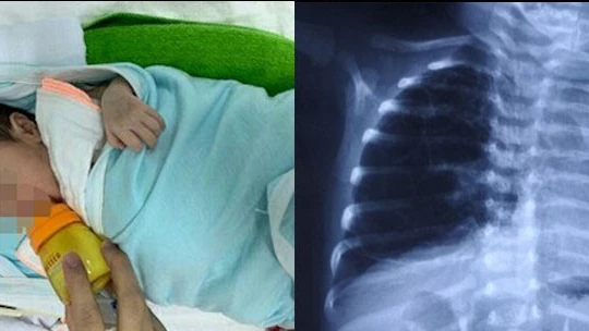 Em bé D.A bị dị dạng đường dẫn khí phổi bẩm sinh
