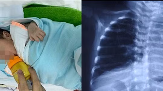 Em bé D.A bị dị dạng đường dẫn khí phổi bẩm sinh
