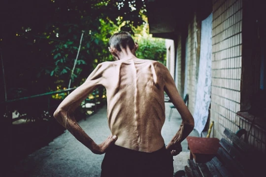 Có đến 90% người mắc nấm phổi Aspergillus chưa được phát hiện, tỷ lệ tử vong lên đến 70%, khó phát hiện đối với cả người bệnh và nhân viên y tế.