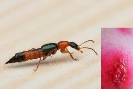 Vết phỏng da do kiến ba khoang cắn