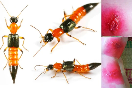 Những vết cắn của kiến ba khoang gây ra tổn thương nghiêm trọng cho da