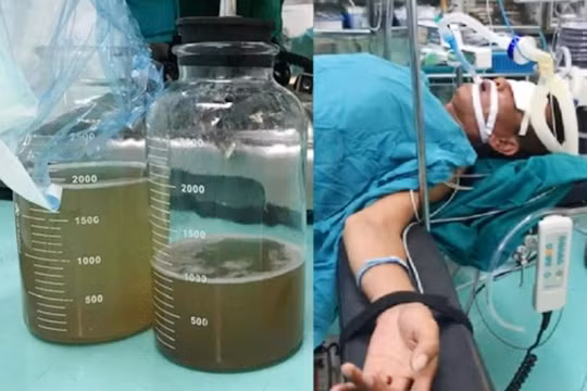 Dùng miệng hút dầu chạy máy xúc, bệnh nhân rơi vào tình trạng suy hô hấp, viêm phổi nặng