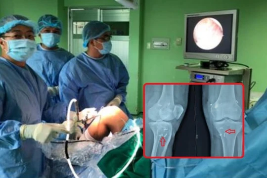 Tiến hành nội soi tái tạo 3 dây chằng khớp gối cho bệnh nhân trong cùng một cuộc phẫu thuật