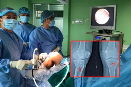Tiến hành nội soi tái tạo 3 dây chằng khớp gối cho bệnh nhân trong cùng một cuộc phẫu thuật