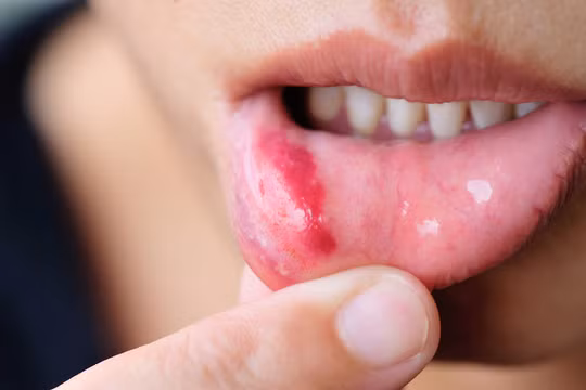 Tưởng chỉ là nhiệt miệng, nào ngờ phát hiện đang mắc ung thư lưỡi 