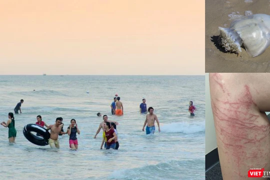 Vết thương do sứa cắn bị mẩn đỏ, ngứa rát