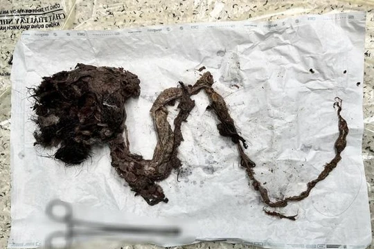 Một búi tóc dài được các bác sĩ Bệnh viện Nhi đồng Thành phố (TP.HCM) lấy ra khỏi ruột một nữ bệnh nhi - Ảnh: Bệnh viện cung cấp