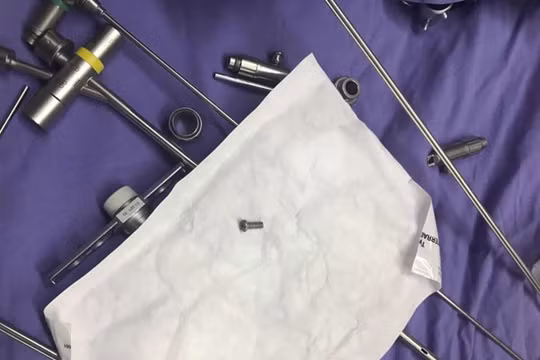 Đinh vít nằm ở đường thở của bệnh nhân nhi tên N. ở Quảng Nam sau khi nội soi gắp ra.