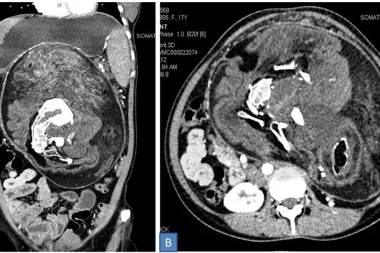Hình ảnh CT scan trường hợp "thai nhi trong bào thai" được phát hiện bên trong bụng của một người phụ nữ Ấn Độ. Ảnh: Gizmodo