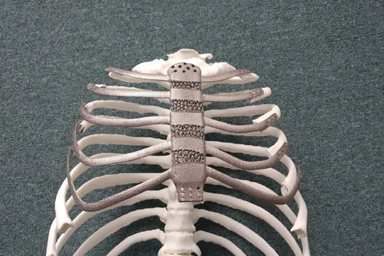 Ca ghép xương ngực nhân tạo bằng công nghệ in 3D đầu tiên tại Hàn Quốc. Ảnh: koreabiomed.com 