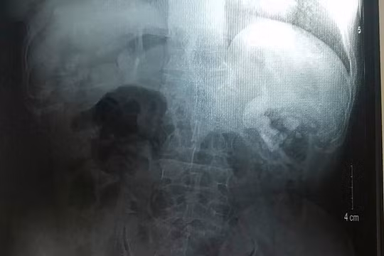 Viên sỏi bàng quang có hình dáng và kích thước tương tự như quả trứng vịt trên phim chụp X-Quang của bệnh nhân T. (ảnh BVCC)