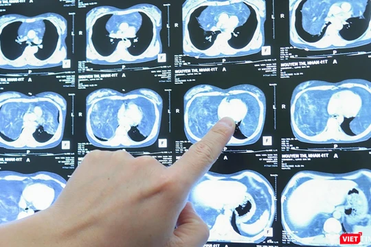 Hình ảnh khối u khổng lồ trong khoang ngực của bệnh nhân M.