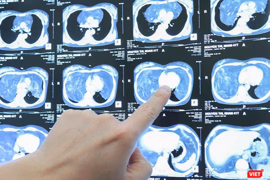 Hình ảnh khối u khổng lồ trong khoang ngực của bệnh nhân M.