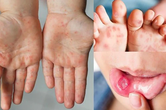 Bệnh tay chân miệng ở trẻ em (ảnh SKĐS)