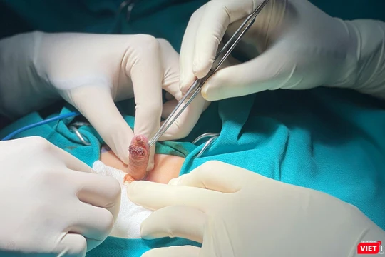 Ca phẫu thuật cắt bỏ khối sùi mào gà dương vật cho bệnh nhi 6 tuổi, giúp bệnh nhân tránh nguy cơ cắt cụt dương vật.