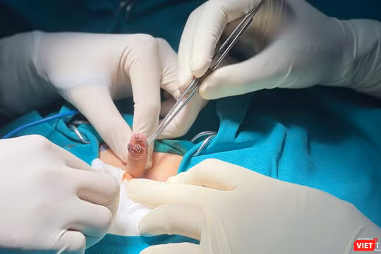 Ca phẫu thuật cắt bỏ khối sùi mào gà dương vật cho bệnh nhi 6 tuổi, giúp bệnh nhân tránh nguy cơ cắt cụt dương vật.