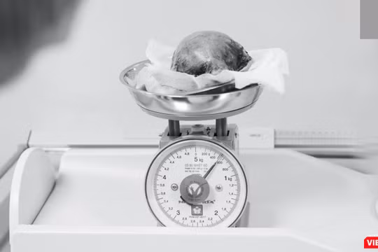 Khối u lấy ra từ tử cung của bệnh nhân H.