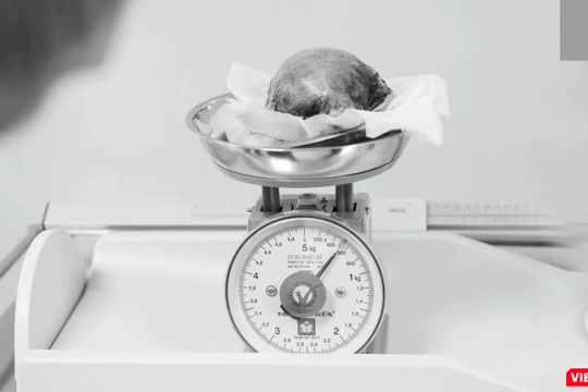 Khối u lấy ra từ tử cung của bệnh nhân H.