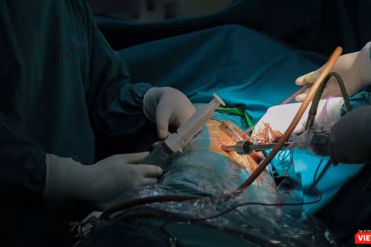 Ê-kíp bác sĩ phẫu thuật do Ths.Bs Nguyễn Văn Lâm – Khoa Ngoại tổng hợp, Bệnh viện đa khoa Đức Giang sử dụng kỹ thuật nội soi để bóc ổ cặn màng phổi nghi do di chứng COVID-19 cho bệnh nhân