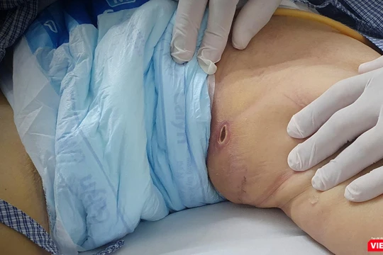 Vết loét điển hình trên vùng bẹn của bệnh nhân sốt mò - một dấu hiệu để phân biệt sốt mò và các bệnh truyền nhiễm khác (ảnh bệnh viện cung cấp)