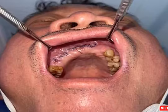 Bệnh nhân sau khi được phẫu thuật điều trị (ảnh bệnh viện cung cấp)