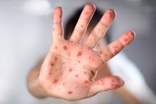 Nguy cơ bùng phát dịch sởi ở Hà Nội và TPHCM