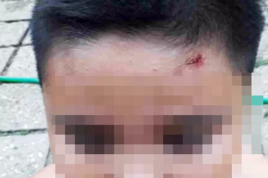 Cháu bé bị bắn sượt vào đầu.