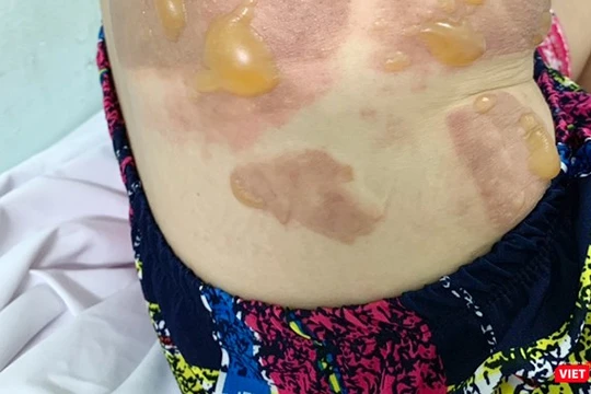 Thương tích trên người nạn nhân Đặng Thị Ngọc L.y